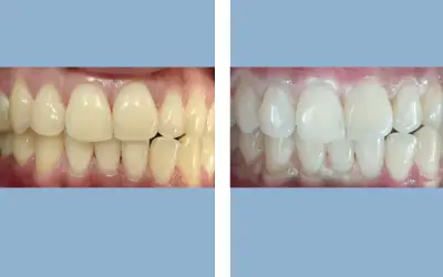 Before and After